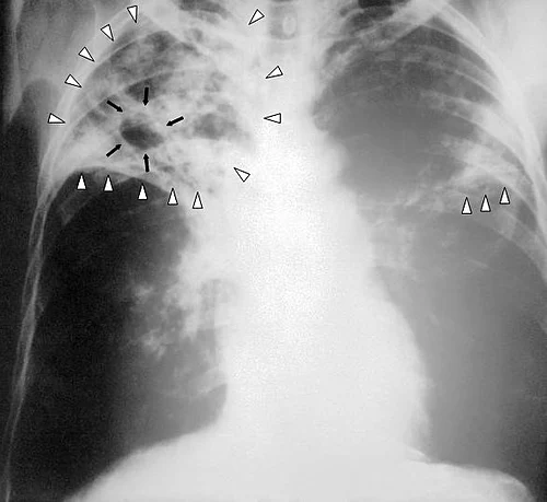 Anderson Uvie-Emegbo Tuberculosis Diagnosis 2006